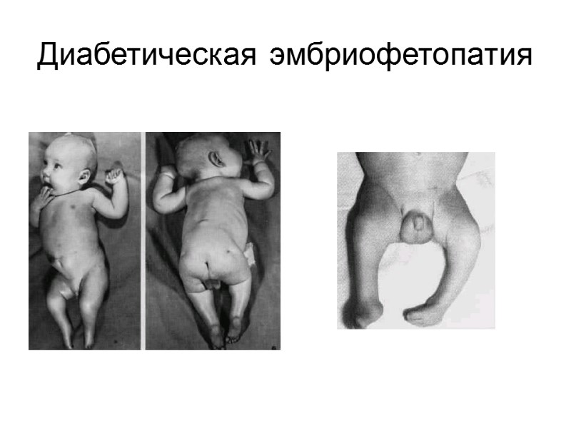 Диабетическая эмбриофетопатия